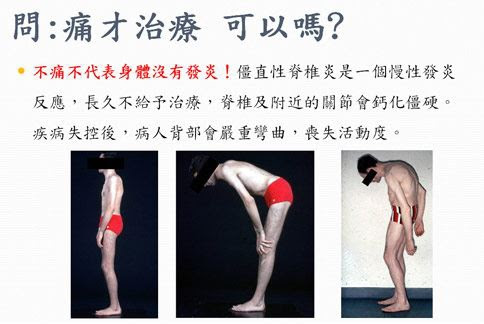天冷抗僵直性脊椎炎三到缺一不可 華貿座椅電梯 世界最佳品質樓梯升降椅