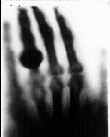 Wilhelm Röntgen's X-ray image of the hand of his wife Anna
