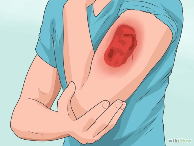 Heal a Cold Sore Naturally Step 20.jpg