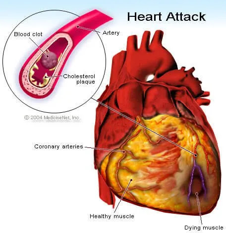 Picture of Heart Attack - Myocardial Infarction