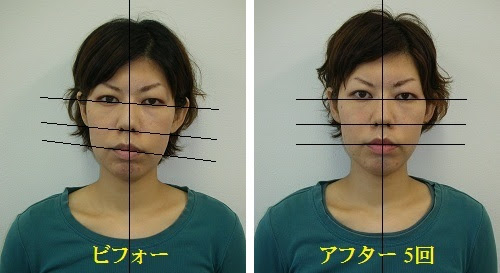 小顔矯正 顔の歪み矯正 ビフォーアフター画像 動画 体験談 関西プロポーション小顔センター大阪梅田院