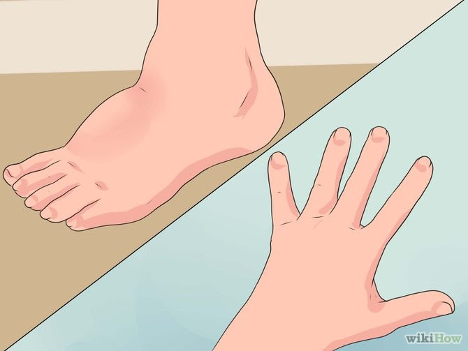 Reduce Edema Naturally Step 1 Version 5.jpg
