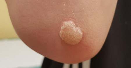 Brodawki Wirusowe Dermatolog Dzieciecy Katowice Dermatolog Katowice