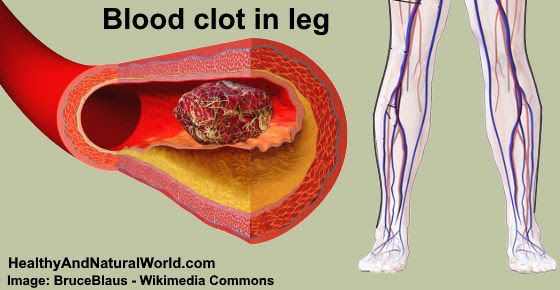 Dvt blood clot in leg symptoms