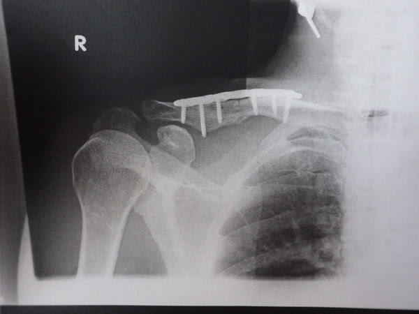 かっしーｂｌｏｇ 鎖骨骨折から１ヶ月経過