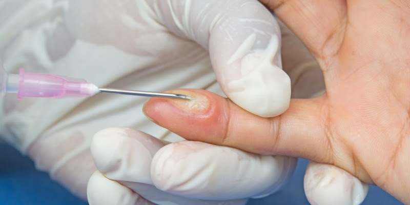 Blase Mit Flussigkeit Gefullter Hohlraum Unter Der Haut Krankheiten Portal De