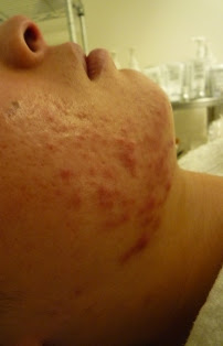 Blog Medical Esthetics Lab メディカル エステティック ラボ