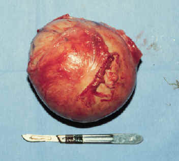 Theca cell tumor
