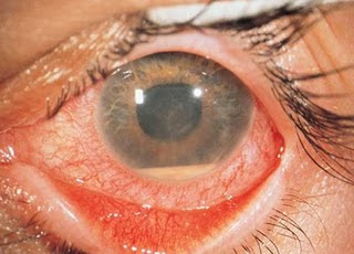 Redness of the eye Blurred vision Photophobia Dark, floating spots 