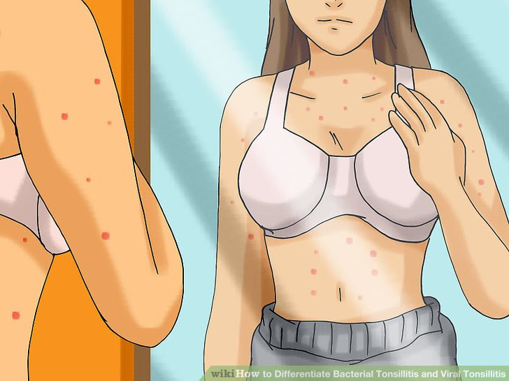 Differentiate Bacterial Tonsillitis and Viral Tonsillitis Step 10.jpg