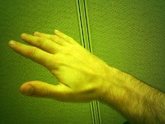 Scaphoid injury