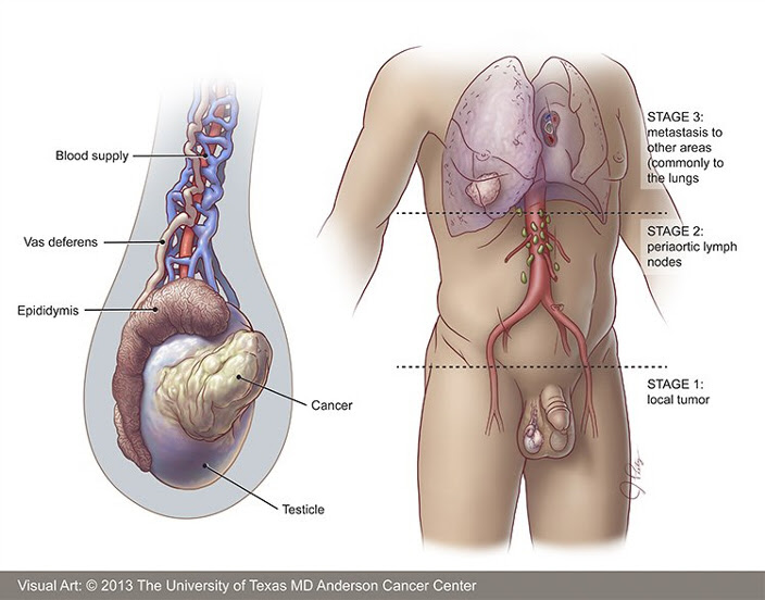Testicular Cancer