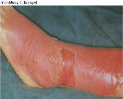 Antibiotika Monitor 3 4 09 Infektionen Der Haut Und Weichteile