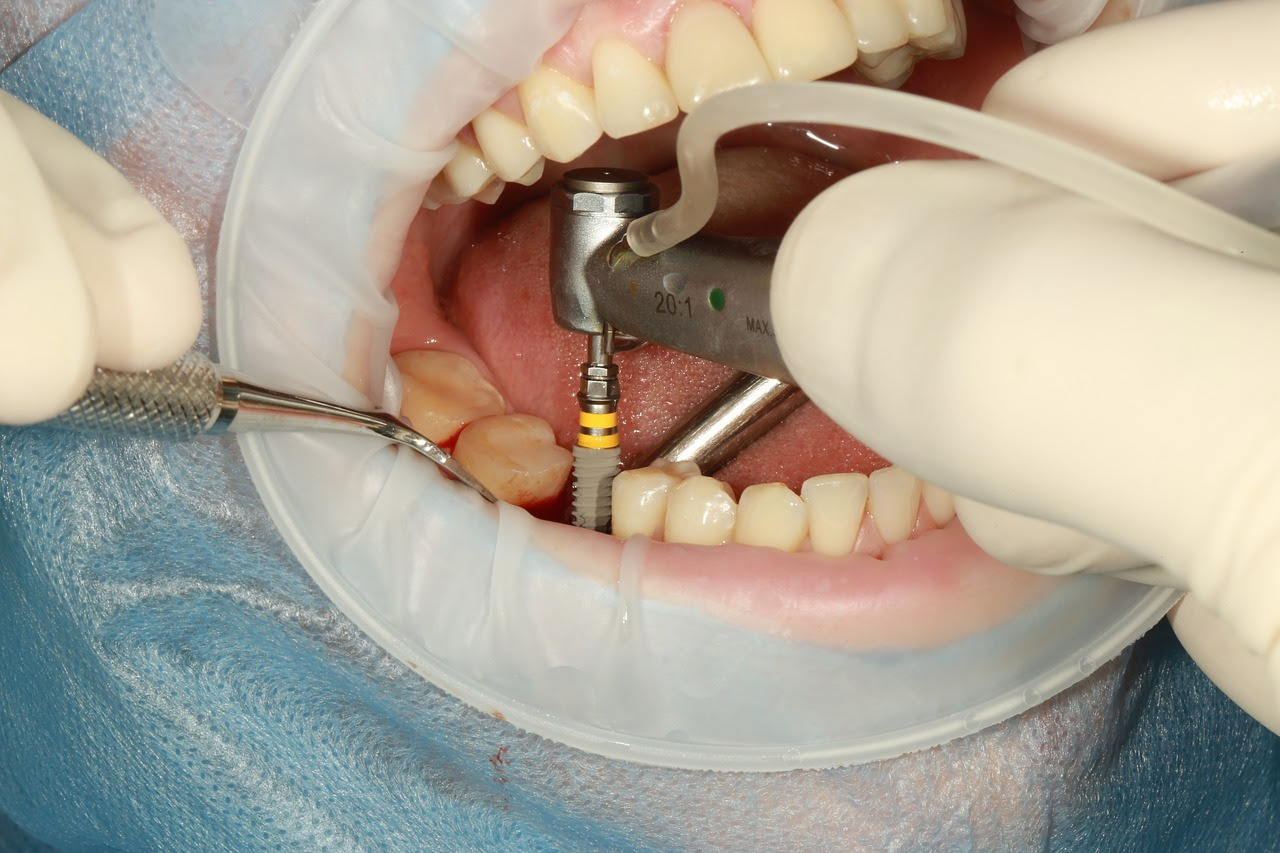 Dental Implant Procedure Stages and Timeline - Optimistic ...