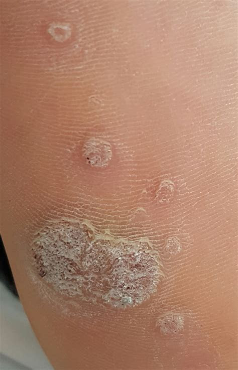 Most people will have one at some po. Foot Wart Treatment and Removal in Orange County