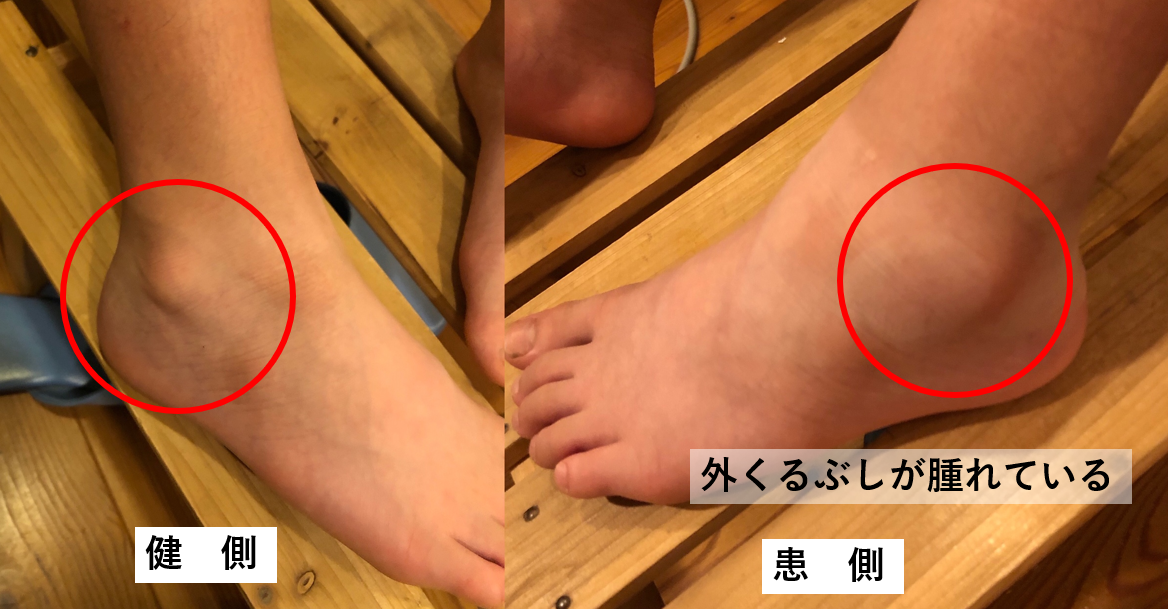 子どもの足首を捻った は 要注意 もしかしたら骨折しているかもしれません すみだ整骨院 直方 飯塚 田川 八幡で整骨院なら