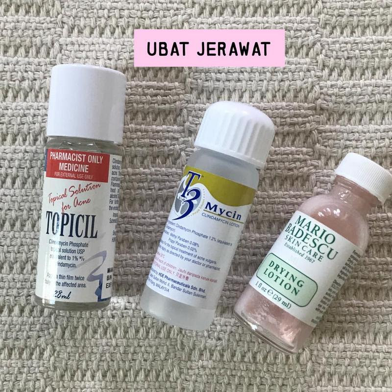 Ubat Hilangkan Parut Jerawat Di Farmasi  Sebenarnya, cara