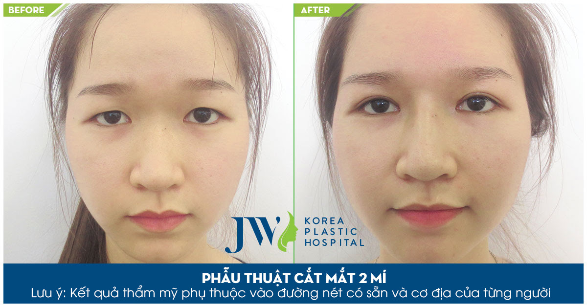 Cắt mí mắt tại Đà Nẵng - Trước và sau