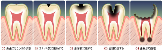 あなたの歯の寿命度を判定します 森田歯科クリニック
