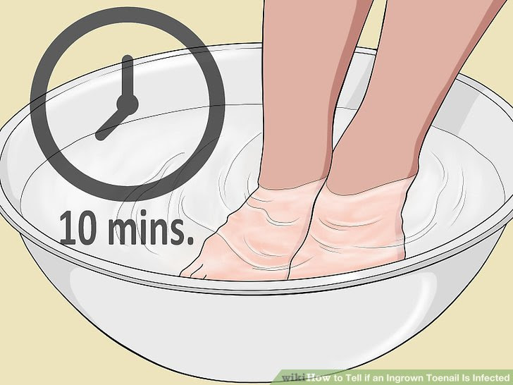 Tell if an Ingrown Toenail Is Infected Step 5.jpg