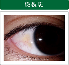 西宮市 ふじもと眼科 目の病気と治療 瞼裂斑 けんれつはん 翼状片 よくじょうへん