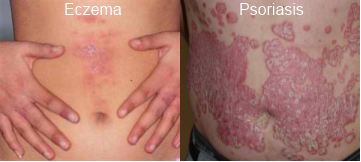are you caught in a maze differentiating psoriasis and eczema