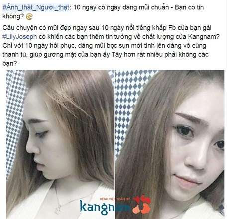 Nâng mũi có hại không777