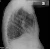 Sarcomatoid Mesothelioma Of Pleural - EPITHELIAL MALIGNANT MESOTHELIOMA â Histopathology.guru
