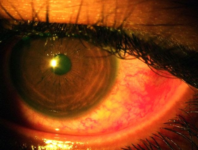 Pemeriksaan Mata - Pusat Pakar Mata ACS - Mata merah, mata 