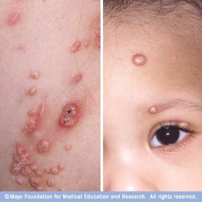 Molluscum contagiosum MSK Pinterest Molluscum contagiosum MSK Pinterest