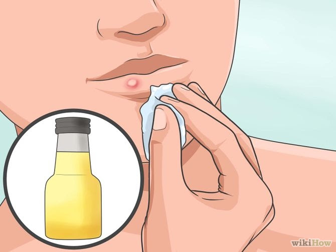 Heal a Cold Sore Naturally Step 7 Version 2.jpg