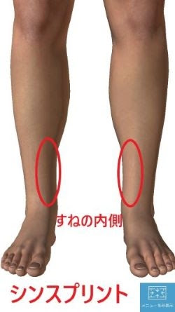 シンスプリント すねの痛み