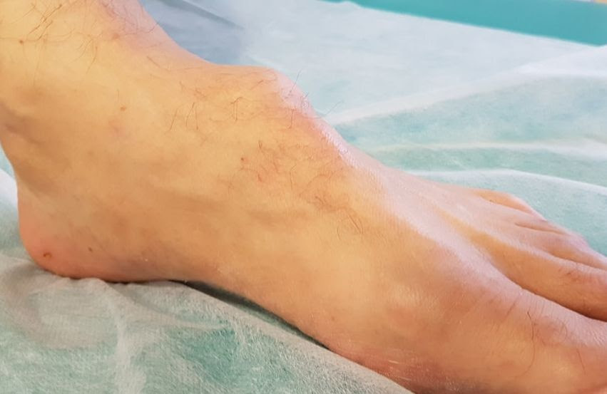 Mejor Tratamiento Para El Ganglion O Quiste En El Pie Cirugia Pie Y Tobillo Dr Ballester