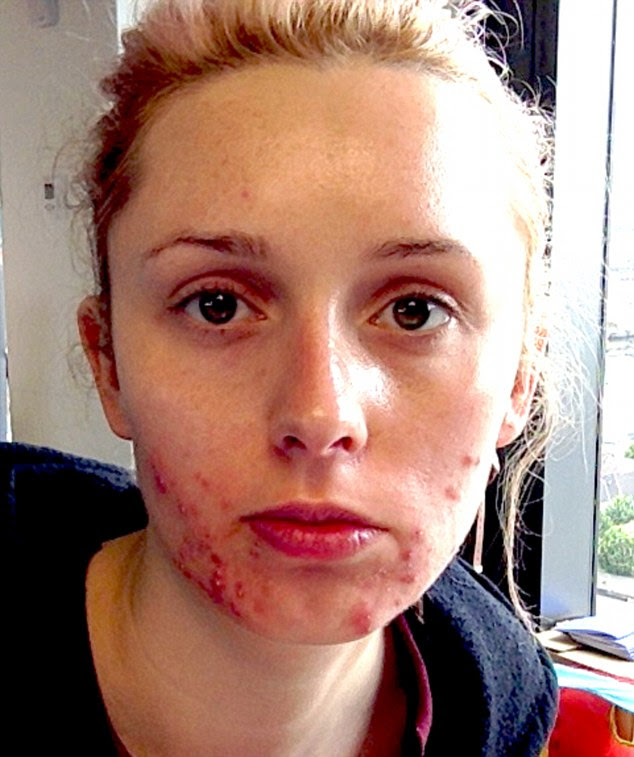 Keeve Angline, 27, developed severe acne at age 24, which left her feeling like a 'monster' and too shy to talk to men, let alone go on a date. She would wake up two hours early every day in order to put on make up and pluck up the courage to go to work. She would go to the gym at 2am in case anyone saw her bare faced