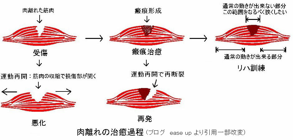 肉離れ 神田大手町の整骨院メディカルスポーツ整骨院 鍼灸院