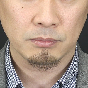 Adhd Hair Inspire Hige アゴヒゲ フジ アゴヒゲ フジ アデランスオンラインショップ 育毛 スカルプ ウィッグ関連通販