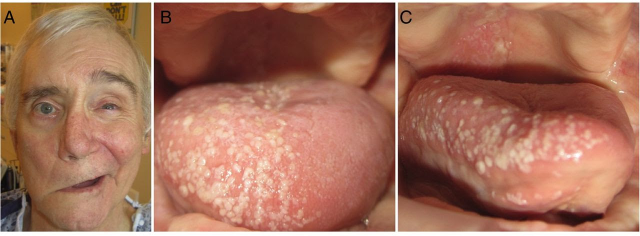 Ramsay Hunt syndrome | Practical Neurology