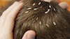 Head Lice - No More an Issue with the Help of Head Removal Service