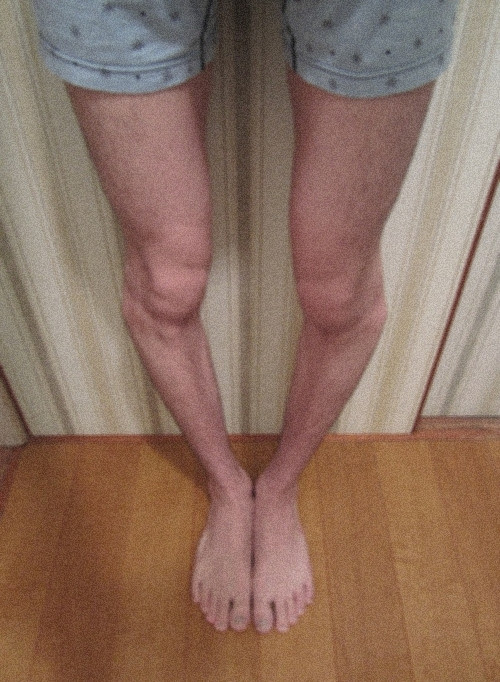 ｏ脚 骨盤の歪みを矯正するスレッド ３
