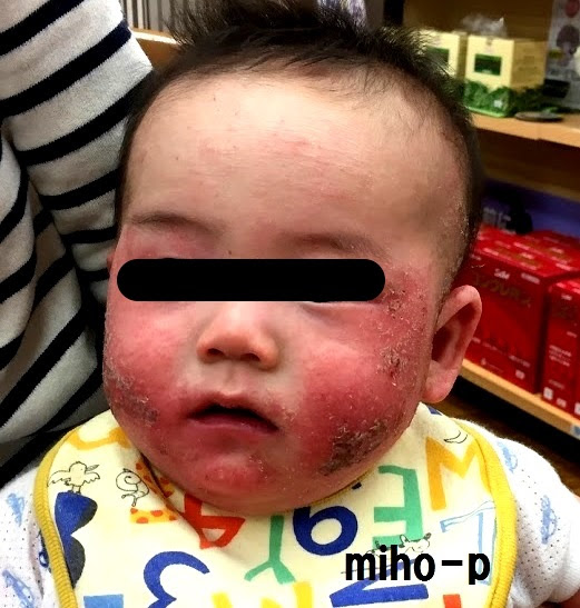 パパとママの努力の賜物 乳児湿疹の改善例 美保薬局 福島県いわき市の皮膚病お悩み相談専門の経験豊富な薬局です