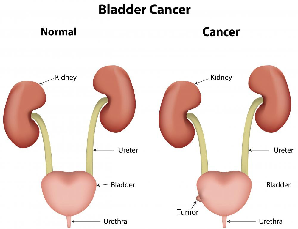 cervical most cancers remedy stage 1