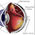 Torn Retina - Retinal Detachment | Krieger Eye : This is called posterior vitreous detachment (pvd).