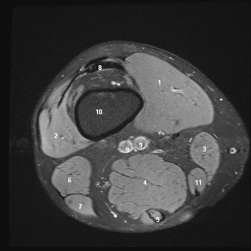knee anatomy mri - DriverLayer Search Engine