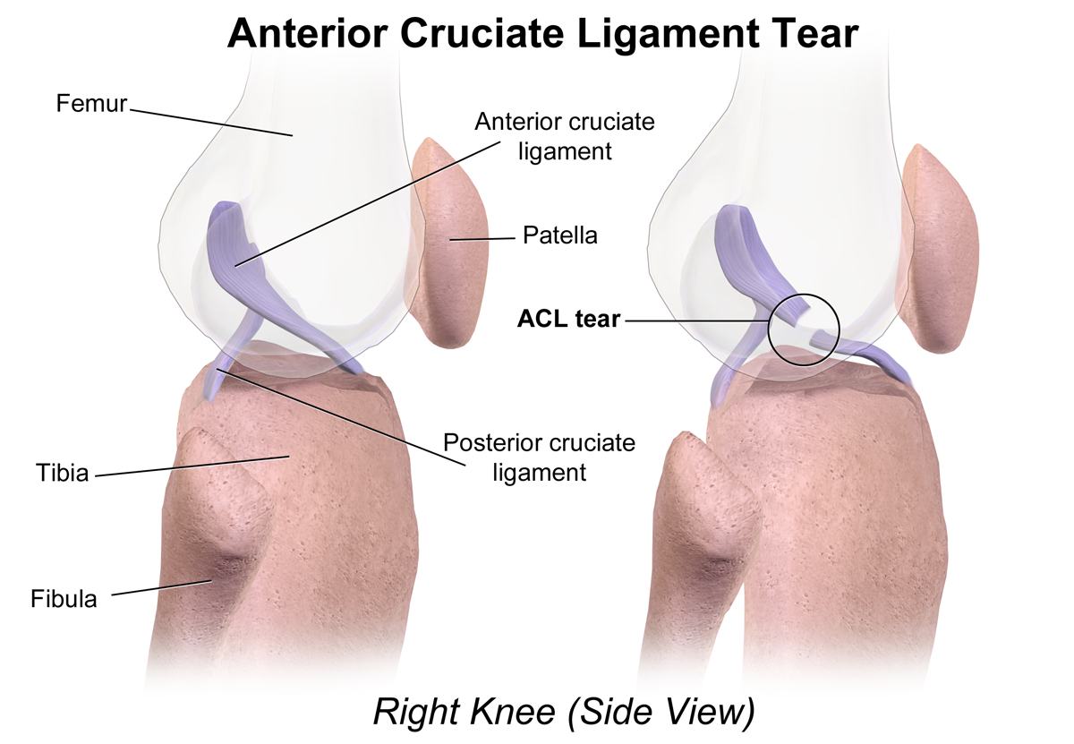 Torn ACL | Symtoms, treatment, surgery 