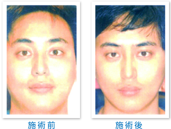 Bnls注射 セントローズクリニック