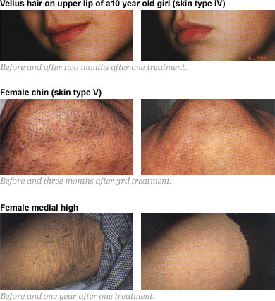 Painless Laserlight Permanenet Hair Removal Reduction Prices