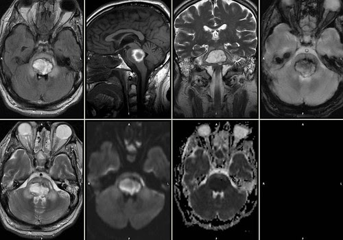 hematoma protuberancial