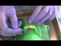 Acid etched retained restoration for a fractured incisor