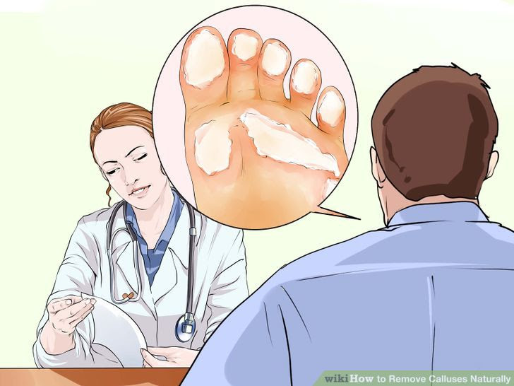 Remove Calluses Naturally Step 12 Version 2.jpg
