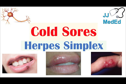 Treatment Of Herpes Simplex Skin Infection